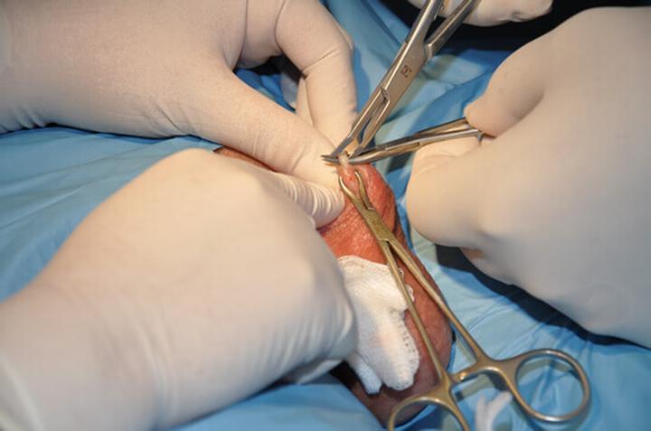 Informacje o wazektomii