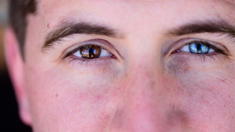 Heterochromia społeczna percepcja